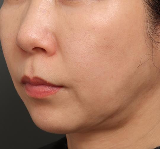 50代女性のジュベルックスキンボトックス After 症例写真