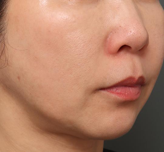 50代女性のジュベルックスキンボトックス After 症例写真