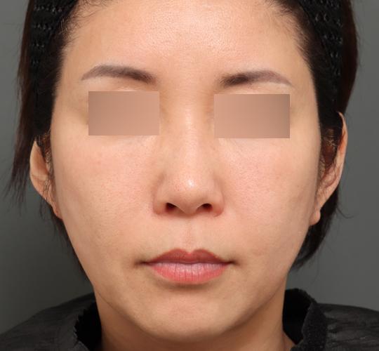 50代女性のシワ・たるみ Before 症例写真