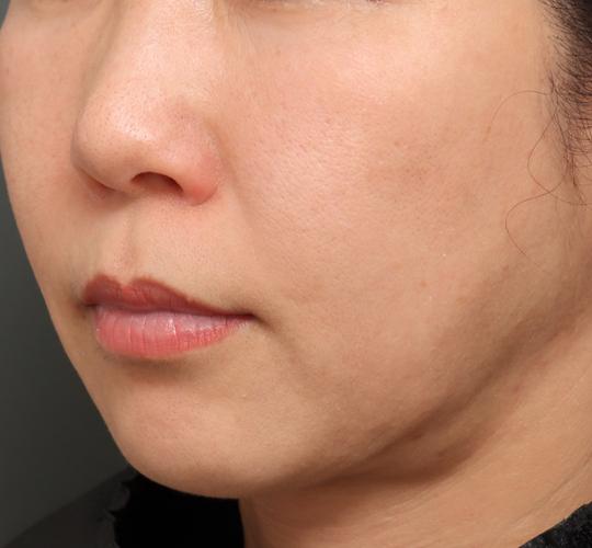 50代女性のジュベルックスキンボトックス Before 症例写真