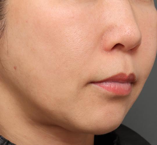 50代女性のジュベルックスキンボトックス Before 症例写真