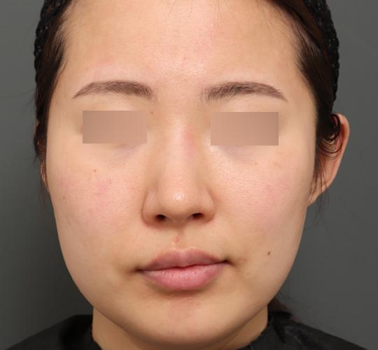 30代女性のジュべルック After 症例写真