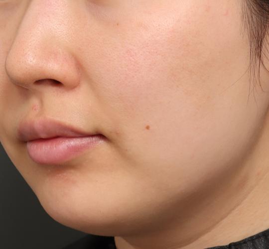 30代女性のジュべルック After 症例写真