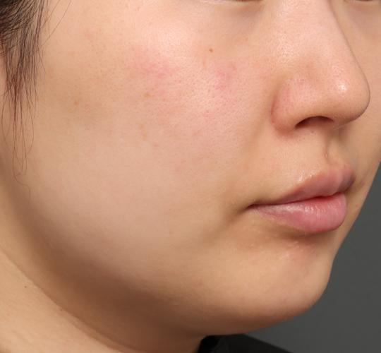 30代女性のシワ・たるみ After 症例写真