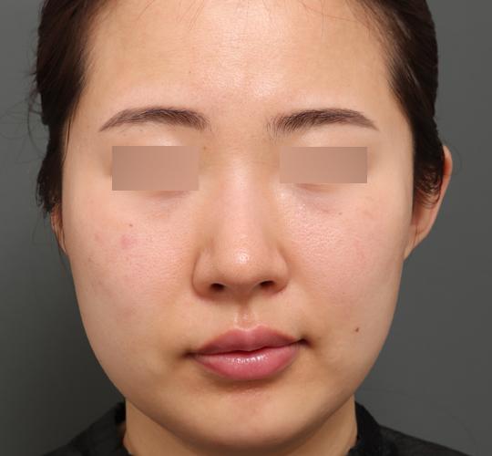 30代女性のジュべルック Before 症例写真