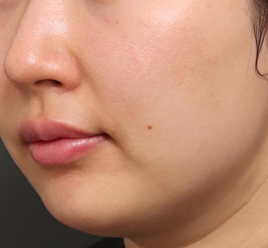 30代女性のジュべルック Before 症例写真