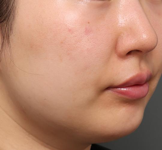 30代女性のシワ・たるみ Before 症例写真