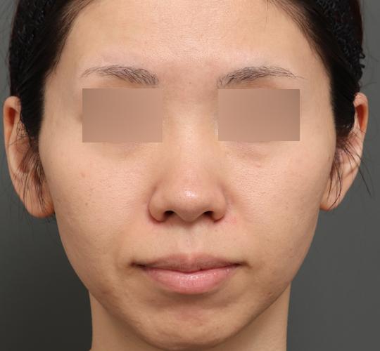 30代女性のジュベルックスキンボトックス After 症例写真