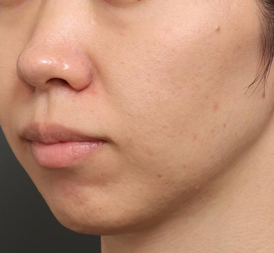 30代女性のジュベルックスキンボトックス After 症例写真