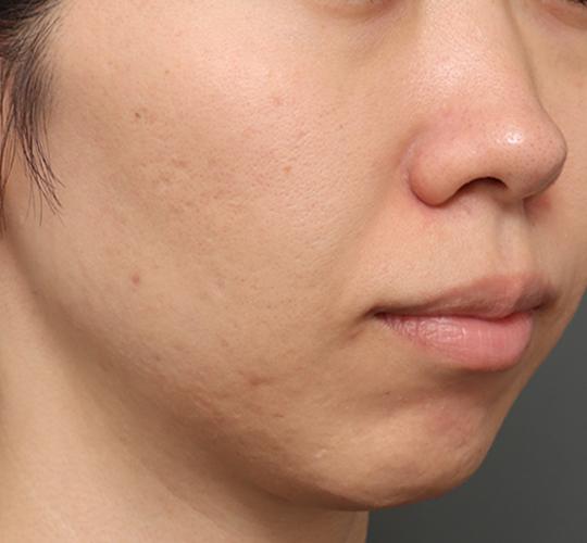 30代女性のシワ・たるみ After 症例写真
