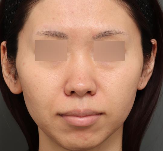 30代女性のジュベルックスキンボトックス Before 症例写真