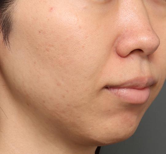 30代女性のシワ・たるみ Before 症例写真