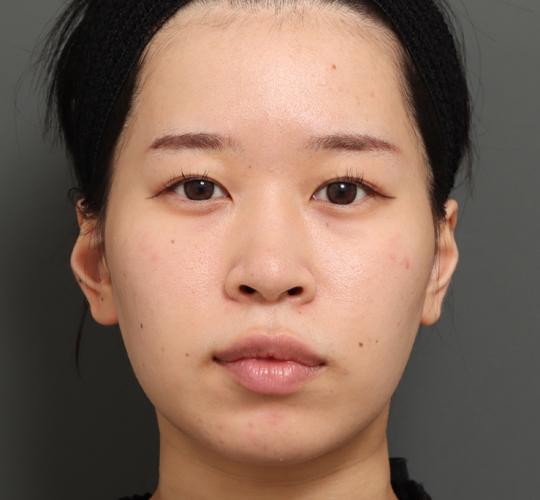 20代女性の顔の脂肪吸引 After 症例写真