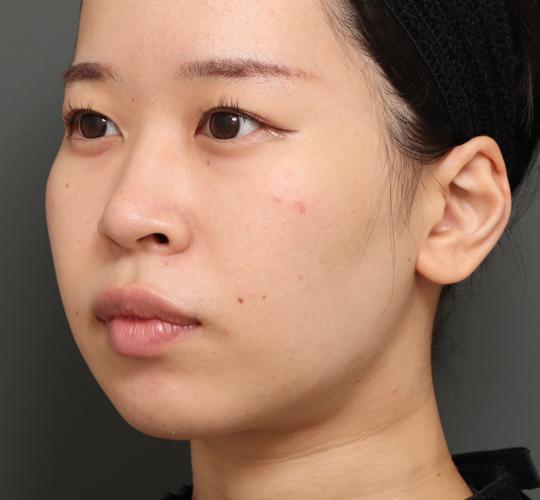 20代女性の顔の脂肪吸引 After 症例写真