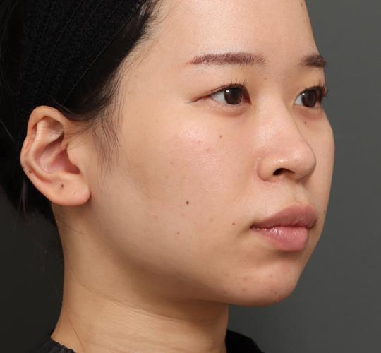 20代女性の顔の脂肪吸引 After 症例写真