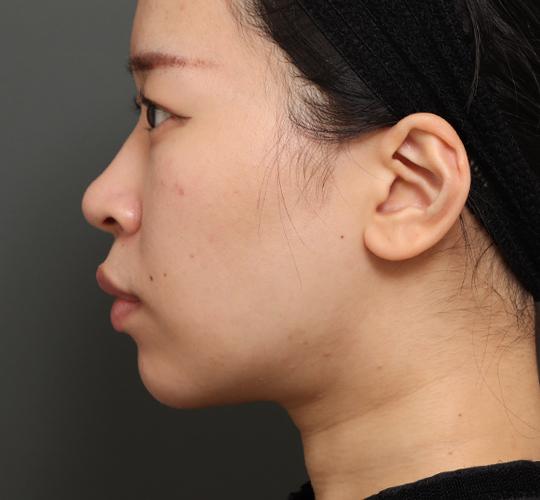 20代女性の顔の脂肪吸引 After 症例写真