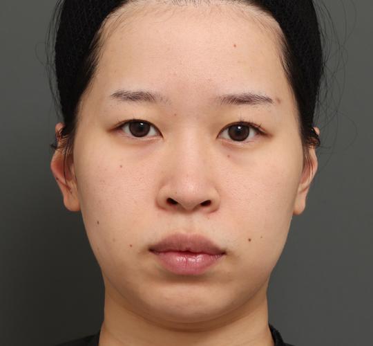 20代女性の顔の脂肪吸引 Before 症例写真