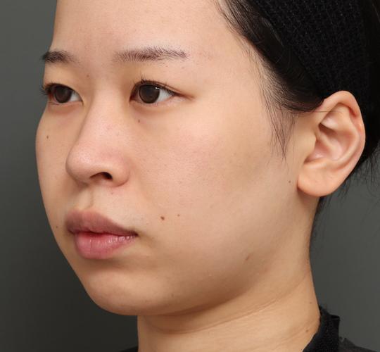 20代女性の顔の脂肪吸引 Before 症例写真