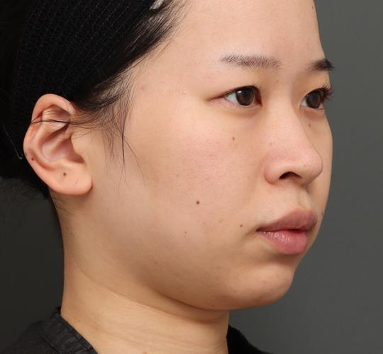 20代女性の顔の脂肪吸引 Before 症例写真