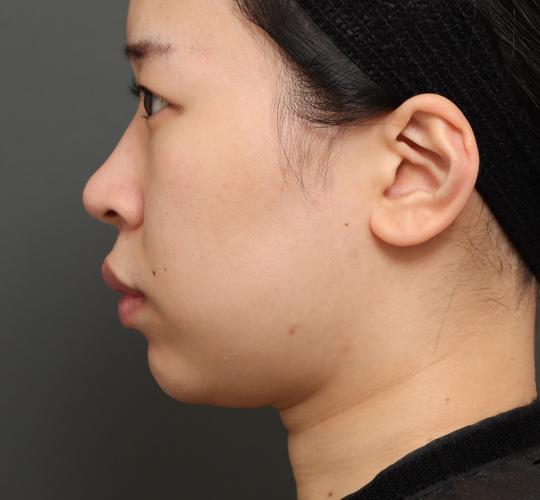 20代女性の顔の脂肪吸引 Before 症例写真