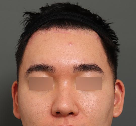 30代男性のシワ・たるみ After 症例写真