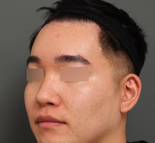 30代男性の額縮小 After 症例写真