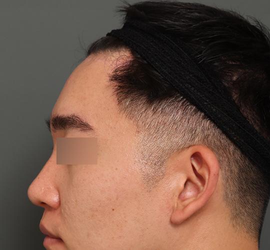 30代男性の額縮小 After 症例写真