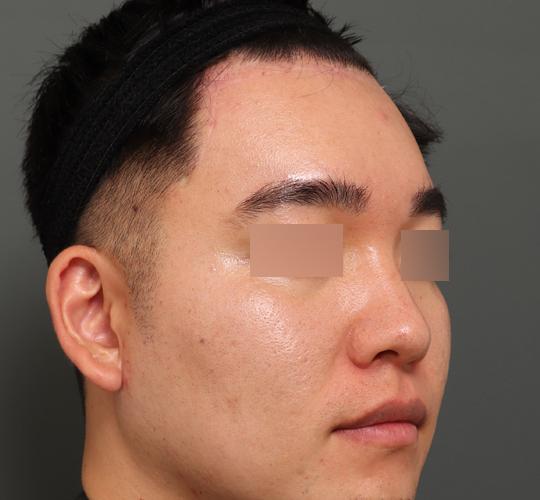 30代男性の額縮小 After 症例写真