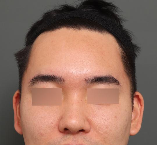 30代男性のシワ・たるみ Before 症例写真