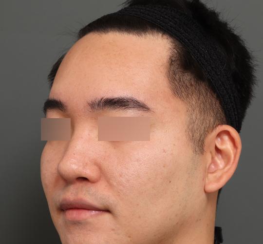 30代男性の額縮小 Before 症例写真