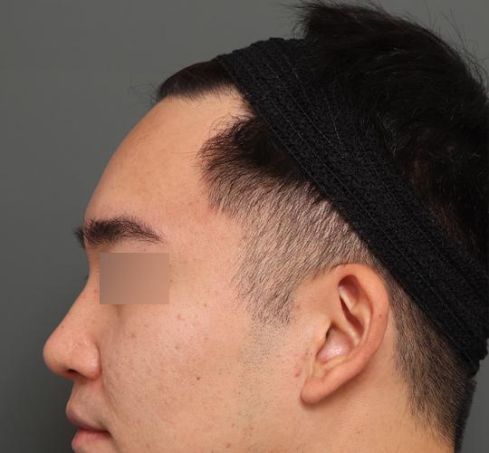 30代男性の額縮小 Before 症例写真