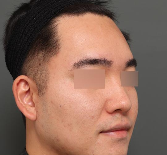 30代男性の額縮小 Before 症例写真