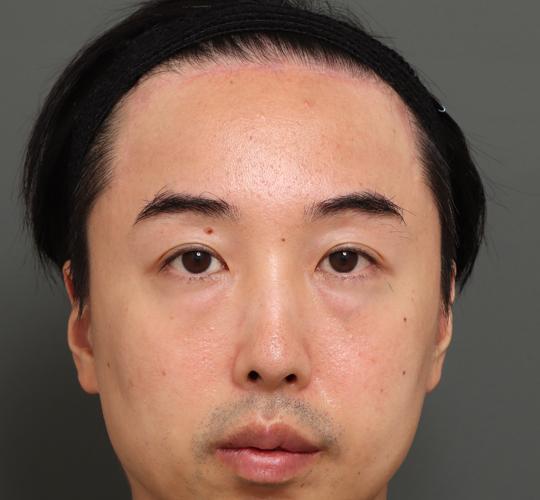 40代男性の額縮小 After 症例写真