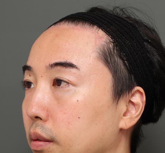 40代男性の額縮小 After 症例写真