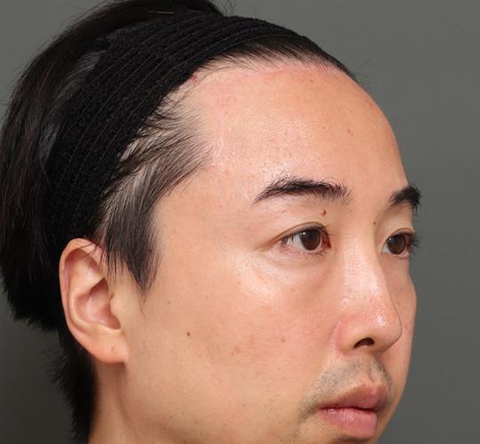 40代男性のシワ・たるみ After 症例写真