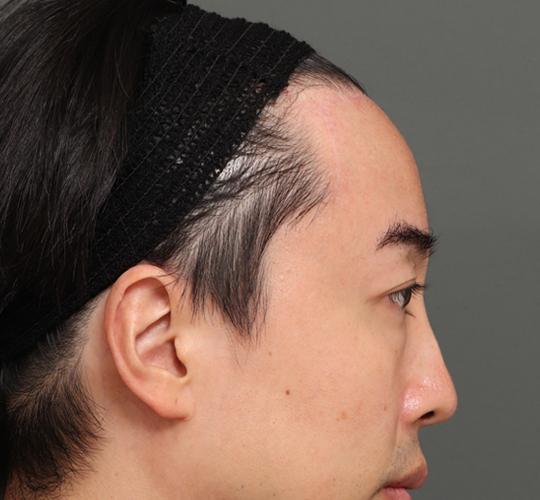 40代男性の額縮小 After 症例写真