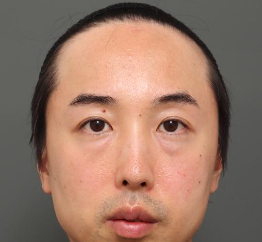 40代男性の額縮小 Before 症例写真