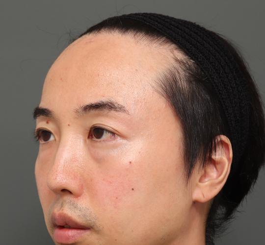 40代男性の額縮小 Before 症例写真