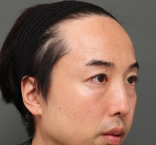 40代男性のシワ・たるみ Before 症例写真