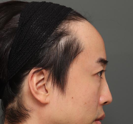40代男性の額縮小 Before 症例写真