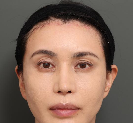 40代女性のシワ・たるみ After 症例写真