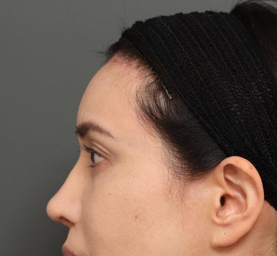 40代女性の額縮小 After 症例写真