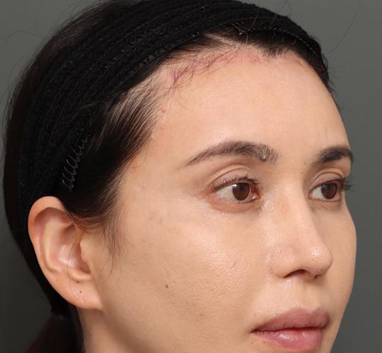 40代女性の額縮小 After 症例写真