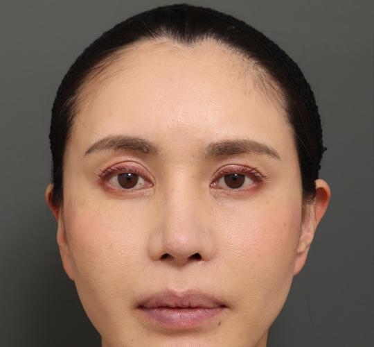 40代女性のシワ・たるみ Before 症例写真