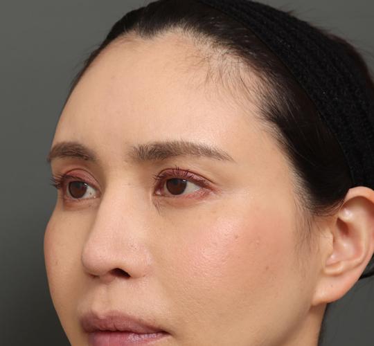40代女性の額縮小 Before 症例写真
