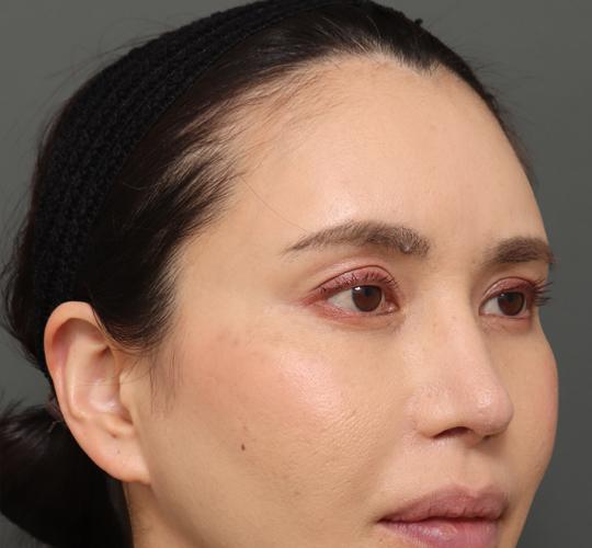 40代女性の額縮小 Before 症例写真