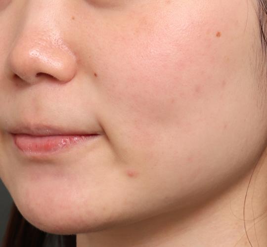 20代女性のジュべルック After 症例写真