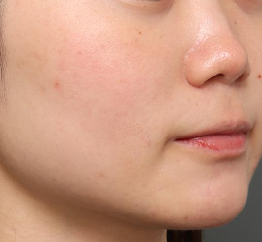 20代女性のジュべルック After 症例写真