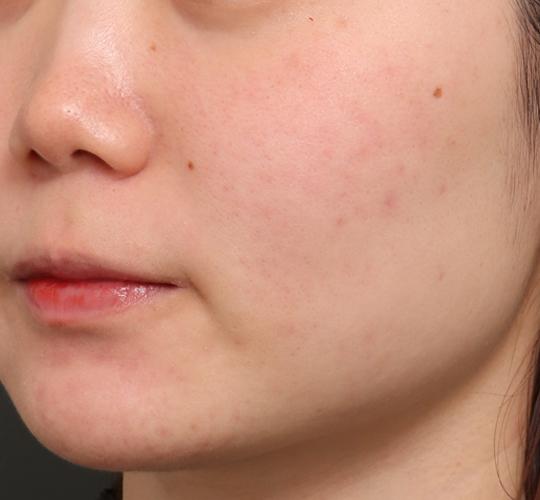 20代女性のジュべルック Before 症例写真