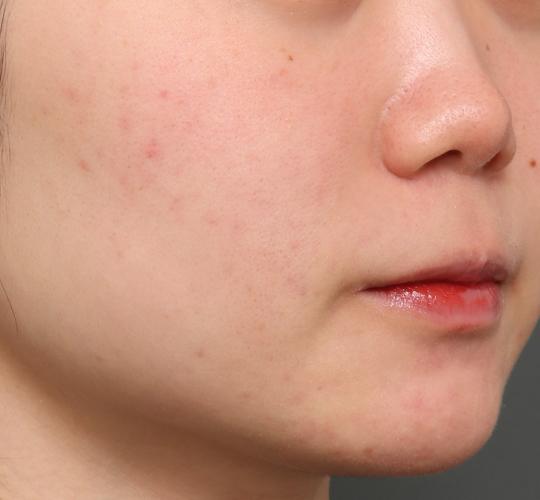 20代女性のジュべルック Before 症例写真